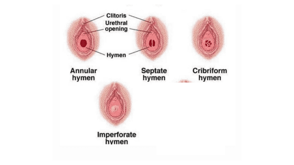hymen types